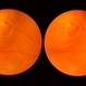 Laser Photocoagulation Laser Photocoagulation