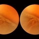 Cyst of the Pars Plana