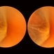 Elevated Cystic Area Elevated Cystic Area