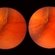 Retinal Lesion Retinal Lesion