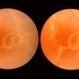 Retinal Detachment Retinal Detachment