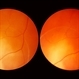 Retinal Detachment Retinal Detachment