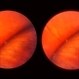 White Retinal Tuft White Retinal Tuft