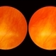 Retinal Detachment Retinal Detachment