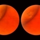Sudden Posterior Vitreous Detachment Sudden Posterior Vitreous Detachment
