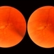 Sudden Posterior Vitreous Detachment Sudden Posterior Vitreous Detachment