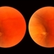 Sudden Posterior Vitreous Detachment Sudden Posterior Vitreous Detachment