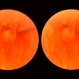 Sudden Posterior Vitreous Detachment Sudden Posterior Vitreous Detachment