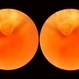 Sudden Posterior Vitreous Detachment Sudden Posterior Vitreous Detachment