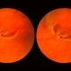 Cystic Retinal Tuft Cystic Retinal Tuft