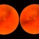 Posterior Vitreous Detachment Posterior Vitreous Detachment