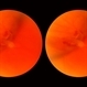 Symptomatic Retinal  Tear Symptomatic Retinal  Tear