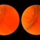 Symptomatic Horseshoe Tear Symptomatic Horseshoe Tear