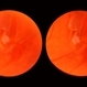 Vitreous Hemorrhage Vitreous Hemorrhage