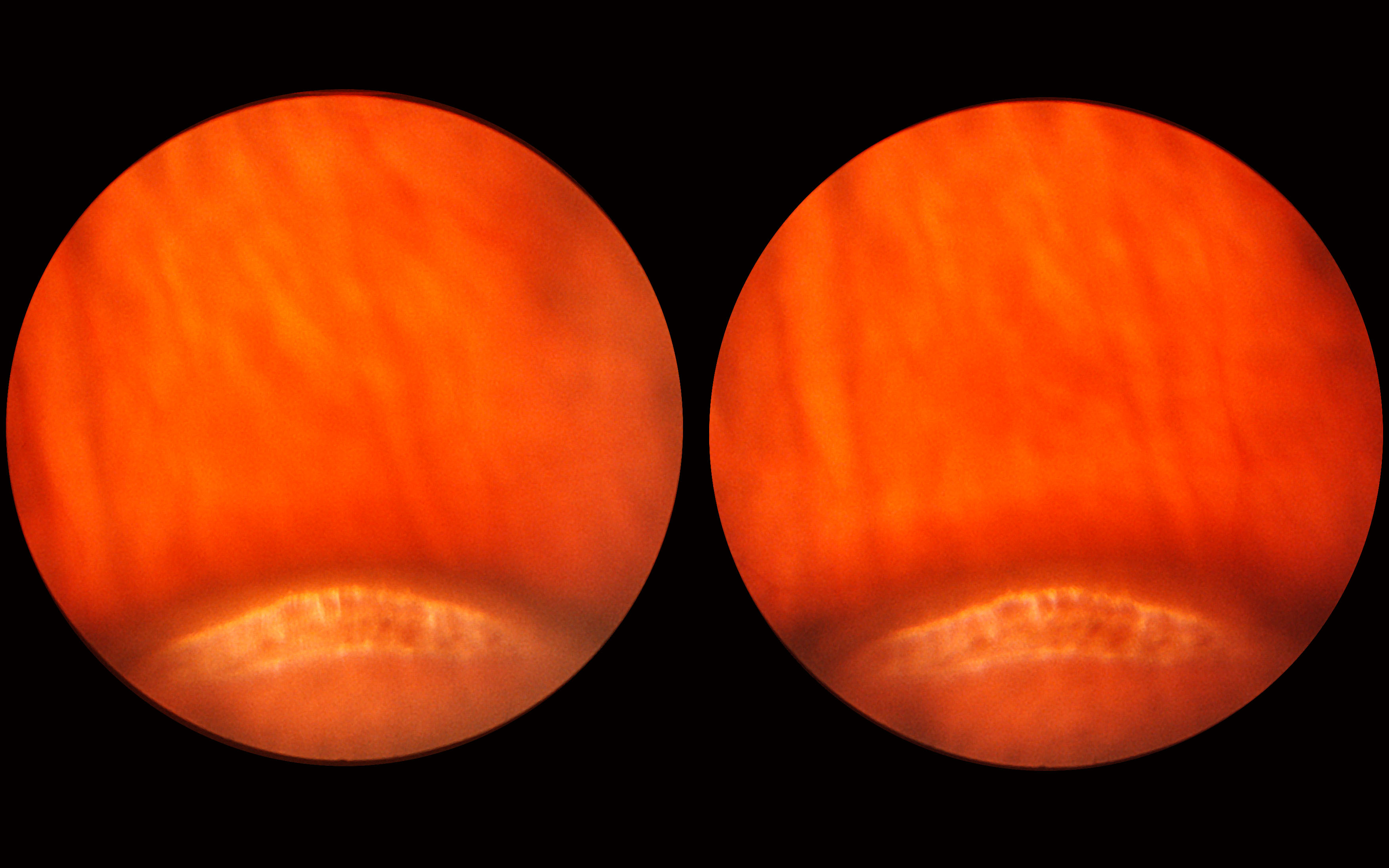 icd 10 lattice degeneration right eye icd 10 lattice degeneration right eye