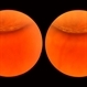 Lattice Lesion Lattice Lesion
