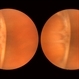 Normal Nasal Ora Serrata Normal Nasal Ora Serrata