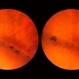 Lattice Lesion Lattice Lesion