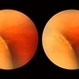 Lattice Lesion Lattice Lesion