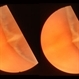 Normal Nasal Ora Serrata Normal Nasal Ora Serrata