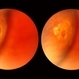 Lattice Lesion Lattice Lesion