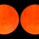 Lattice Lesion Lattice Lesion
