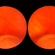 Lattice Lesion Lattice Lesion