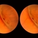Lattice Lesion Lattice Lesion