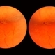 Flat Lattice Lesion Flat Lattice Lesion