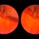 Retinal Tear in Aphakic Fellow Eye Retinal Tear in Aphakic Fellow Eye