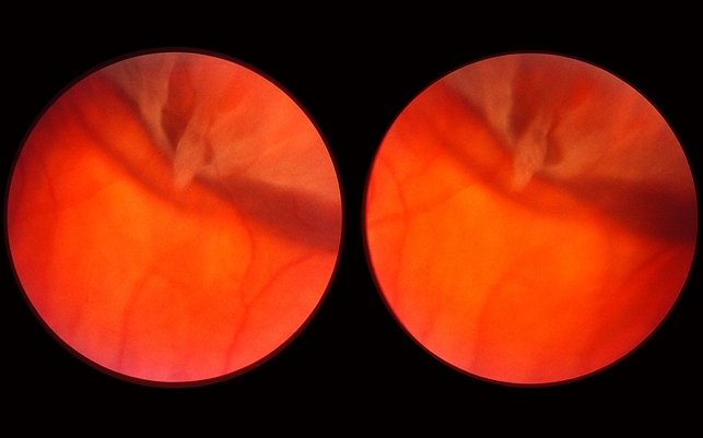 Retinal Tear in Aphakic Fellow Eye - Retina Image Bank