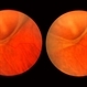 Acute Retinal Detachment Acute Retinal Detachment