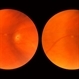 Asymptomatic Tractional Tear Asymptomatic Tractional Tear