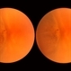 Retinal Break Retinal Break