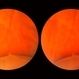 Elevated Lesion Elevated Lesion