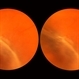 Aphakic Retinal Detachment Aphakic Retinal Detachment