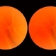 Retinal Detachment Retinal Detachment