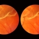Aphakic Retinal Detachment Aphakic Retinal Detachment