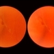 Retinal Detachment Retinal Detachment