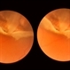 Dialysis of Retina in Upper Nasal Quadrant Dialysis of Retina in Upper Nasal Quadrant