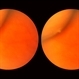 Peripheral Retinal Lesion Peripheral Retinal Lesion