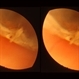 Congenital Meridional Congenital Meridional