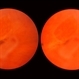 Inactive Toxoplasmosis Inactive Toxoplasmosis