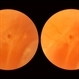 Pars Planitis - Peripheral Uveitis Pars Planitis - Peripheral Uveitis