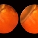 Lattice Lesion Lattice Lesion