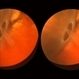 Retinal Break at Site of Lattice Degeneration with Scleral Indentation Retinal Break at Site of Lattice Degeneration with Scleral Indentation