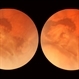 Subclinical Retinal Detachment Subclinical Retinal Detachment