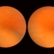 Retinoschisis Retinoschisis