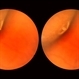 Asymptomatic Lesion Asymptomatic Lesion
