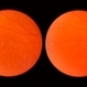 Retinoschisis Retinoschisis